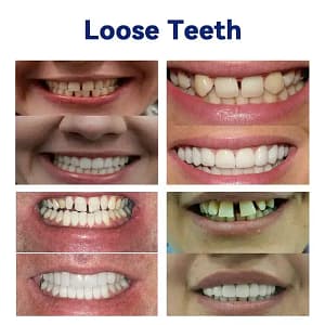 HZA™-Advanced Customized Full Denture Set