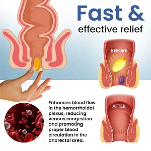 Cvreoz® Natural Hemorrhoid Capsules