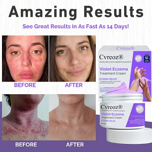 Cvreoz® Violet Eczema Treatment Cream