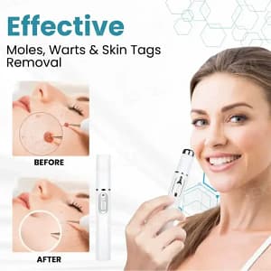 DermaZap™ Non-Invasive Mole and Wart Removal Laser Pen