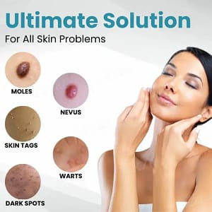 DermaZap™ Non-Invasive Mole and Wart Removal Laser Pen