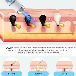 LAOZIK® Non-Invasive Mole and Wart Removal Laser Pen