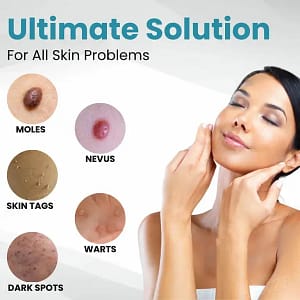 LAOZIK® Non-Invasive Mole and Wart Removal Laser Pen