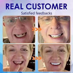 HZA™-Advanced Customized Full Denture Set