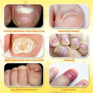 Fivfivgo® ClariNail Bee Venom Fungal Solution Drops
