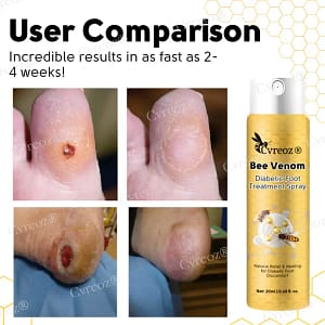 Cvreoz® Bee Venom Diabetic Foot Treatment Spray