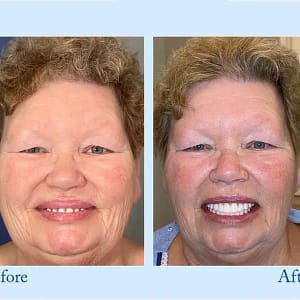 Hidone® Advanced Customized Full Denture Set