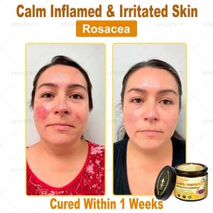 APKAPK™ Bee Venom Skin Treatment Cream