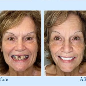 Hidone® Advanced Customized Full Denture Set