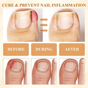 Fivfivgo® Fungiclear Bee Therapy Nail Spray
