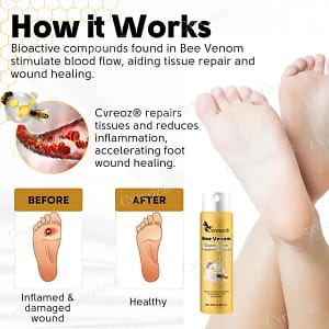Cvreoz® Bee Venom Diabetic Foot Treatment Spray