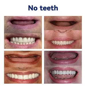 HZA™-Advanced Customized Full Denture Set