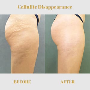 Fivfivgo™ Collagen Buttock Enlargement Patch