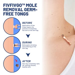 Fivfivgo™ Mole Removal Germ-Free Tongs