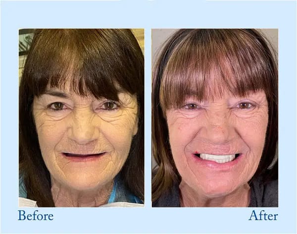 Hidone® Advanced Customized Full Denture Set