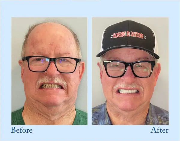 Hidone® Advanced Customized Full Denture Set
