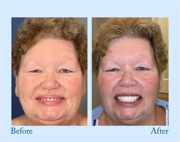 Hidone® Advanced Customized Full Denture Set