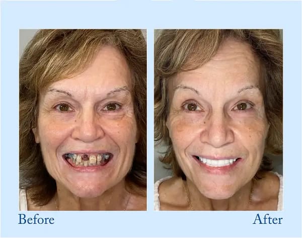 Hidone® Advanced Customized Full Denture Set