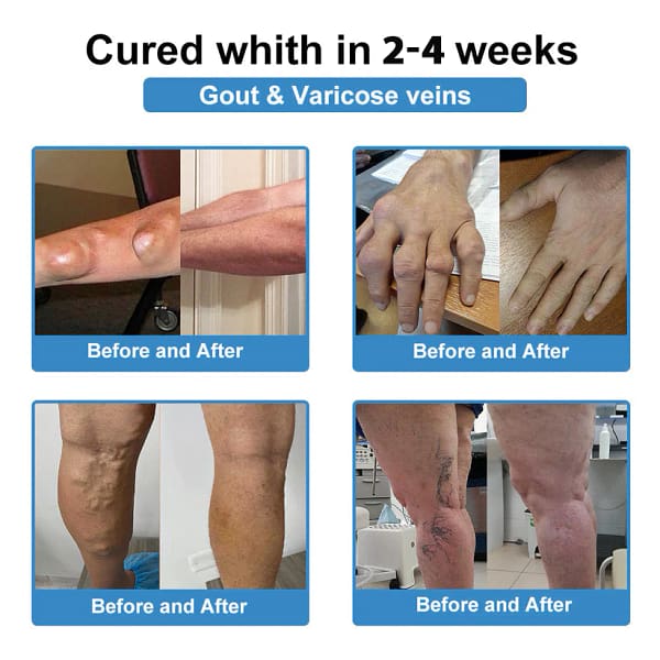 Thonesr® Nano-microneedle joint patch
