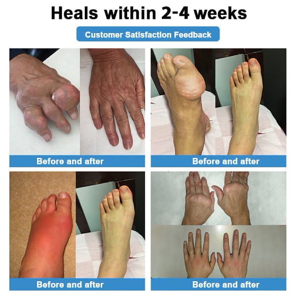 Thonesr® Nano-microneedle joint patch