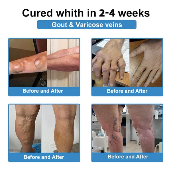 Fivfivgo® Nano-Microneedle Joint Patch