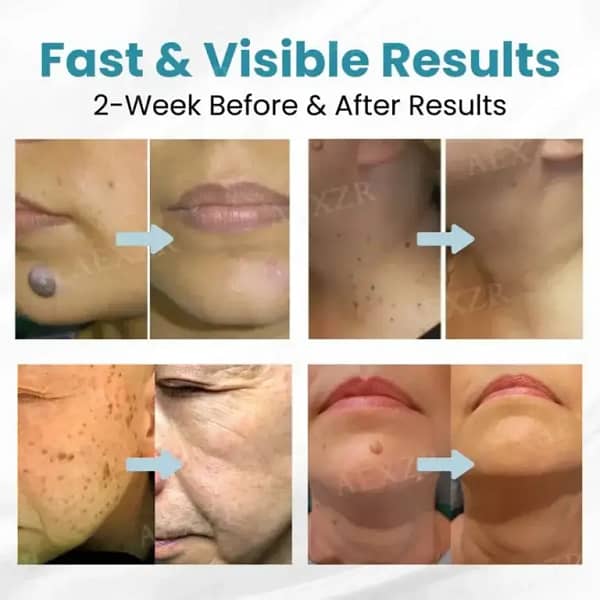 DermaZap™ Non-Invasive Mole and Wart Removal Laser Pen