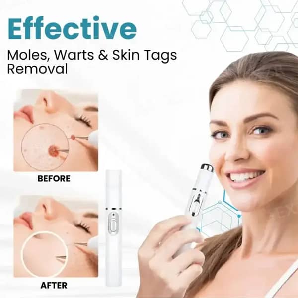 DermaZap™ Non-Invasive Mole and Wart Removal Laser Pen