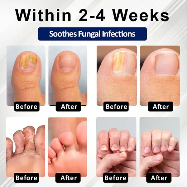 Fivfivgo® Fungiclear Bee Therapy Nail Spray