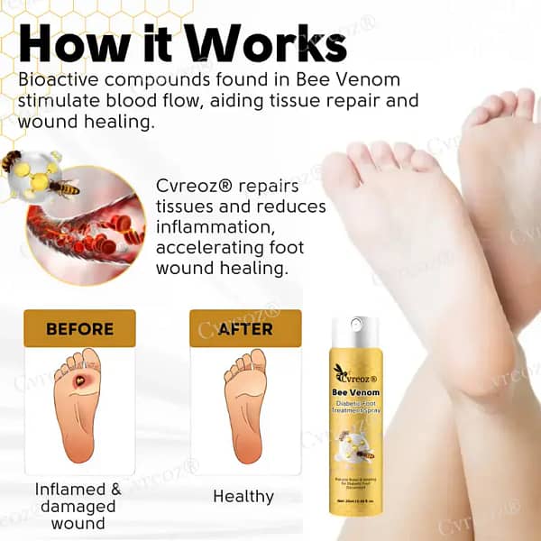 Cvreoz® Bee Venom Diabetic Foot Treatment Spray