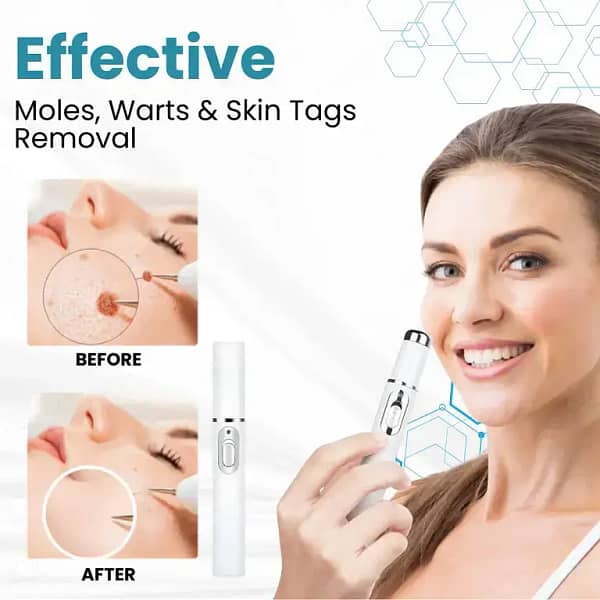 LAOZIK® Non-Invasive Mole and Wart Removal Laser Pen