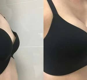 Elycura™ Nano Microneedle Breast Patch