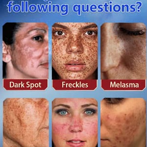 Bikenda™ Blemish Removing Beauty Cream