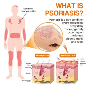 PsoriaHeal Psoriasis Spray Pro