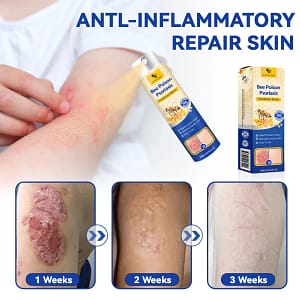 PsoriaHeal Psoriasis Spray Pro