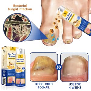 PsoriaHeal Psoriasis Spray Pro