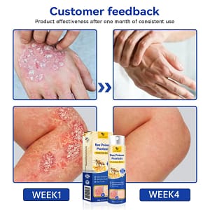 PsoriaHeal Psoriasis Spray Pro