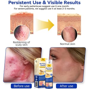 PsoriaHeal Psoriasis Spray Pro