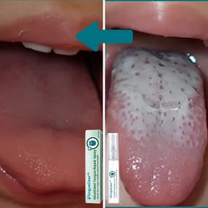 TongueClear™ | Relieves sore tongue and white coating