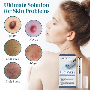 DAFEILA® LumeSkin Mole and Wart Removal Laser Pen