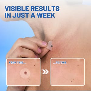Fivfivgo® Moles & Warts Removing Skin Tag Patch