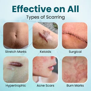 Zvoevo® Advanced Scar Gel