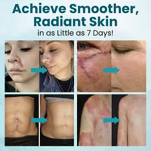 Zvoevo® Advanced Scar Gel