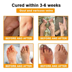 ADNOON® Botulinum Toxin & Bee Venom Pain-Relief Bone Healing Cream