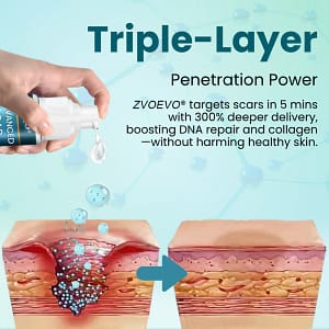 Zvoevo® Advanced Scar Gel