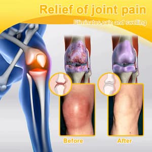 ADNOON® Botulinum Toxin & Bee Venom Pain-Relief Bone Healing Cream