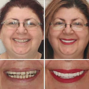 BQYOOM™ Premium Dentures