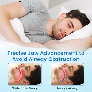 QIAWI™ DreamGuard: Anti-Snoring & Teeth Grinding Mouthpiece