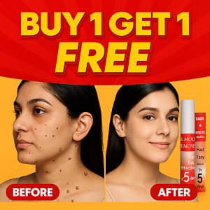 LOVILDS™ Warts & Tags Remover