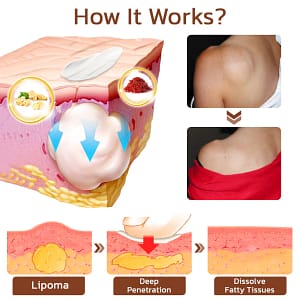 Cvreoz® Lumpless Lipoma Treatment Cream
