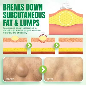 NEGUSY™Advanced Lipoma & Nodule Treatment Cream